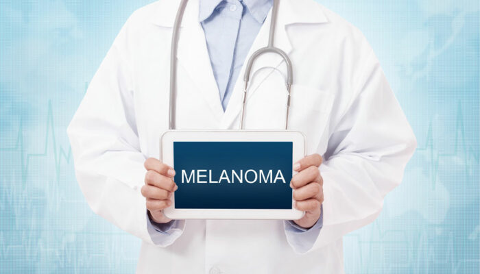 3 effective tips for dealing with melanoma