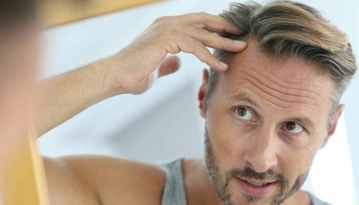 7 Medical Conditions That Can Trigger Hair Loss