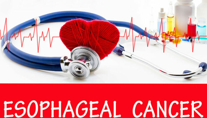 Esophageal cancer – Signs, causes, and management
