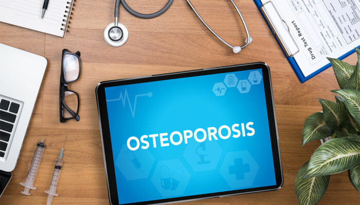 Follow these eating habits and other tips to manage osteoporosis