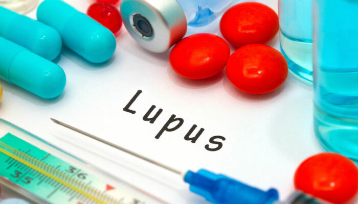 Lupus &#8211; Symptoms, Risk Factors, and Diagnosis